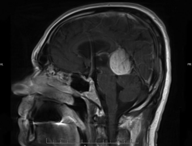 Falcotentorial meningioma near the pineal region.