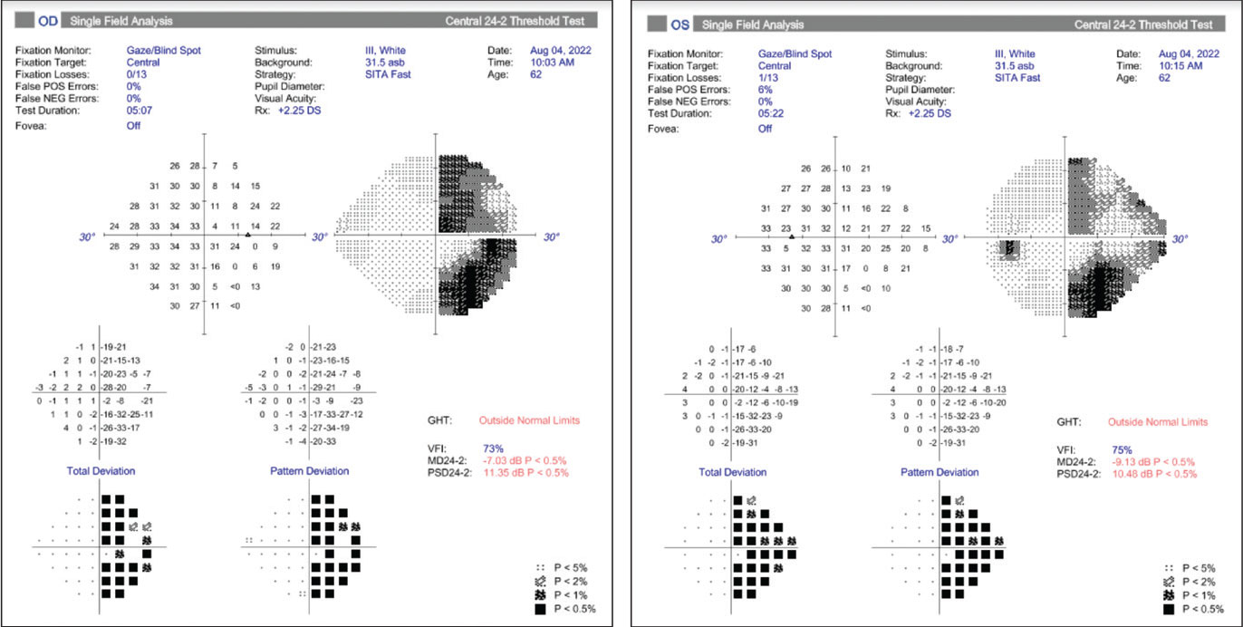 24-2 Humphrey visual fields showing non-absolute, right homonymous hemianopsia, denser superiorly with macular sparing inferiorly.