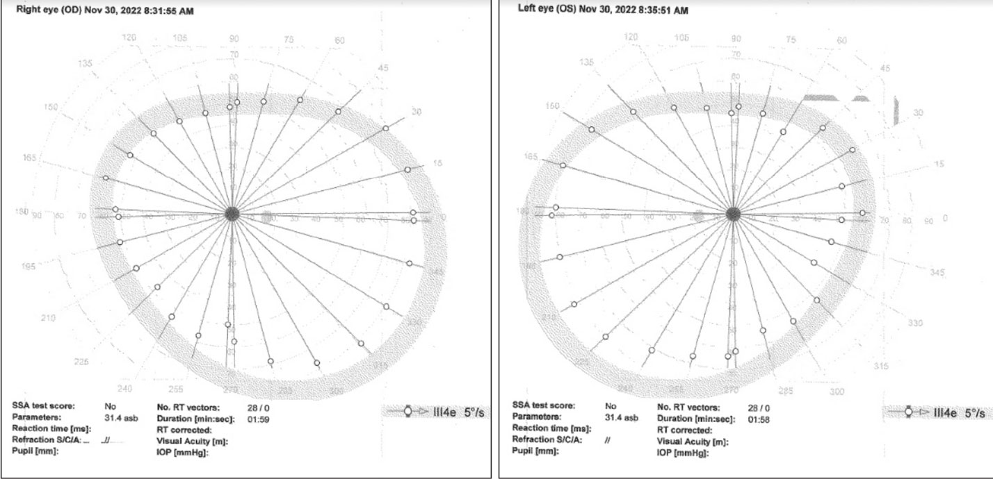 Octopus kinetic visual field using a III 4e target at 5°/sec showing only slight constriction.