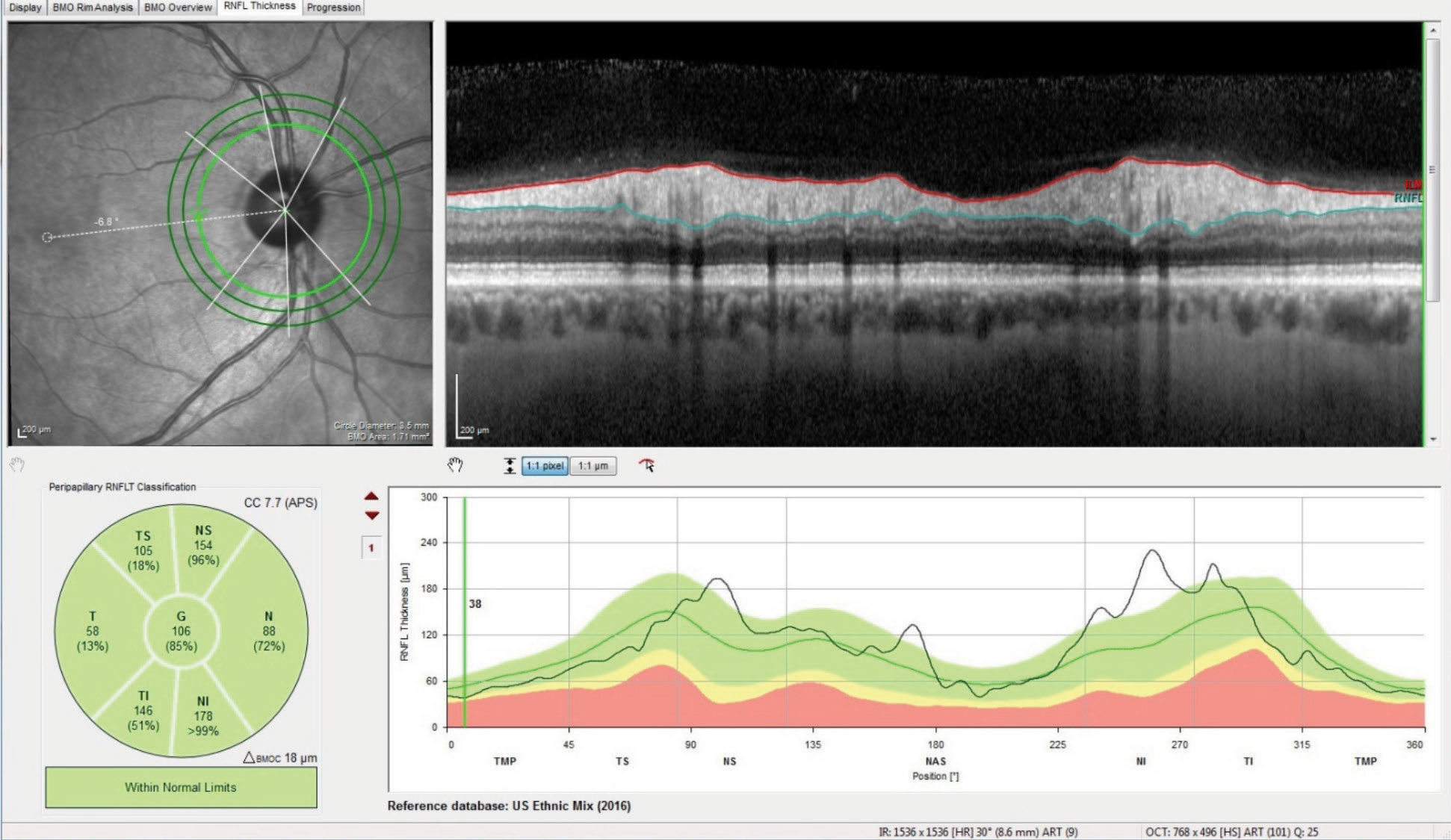 Baseline RNFL 3.5mm circle scans were obtained following the carotid artery stenting and failed PCA stenting. This image was taken three months after initial presentation.