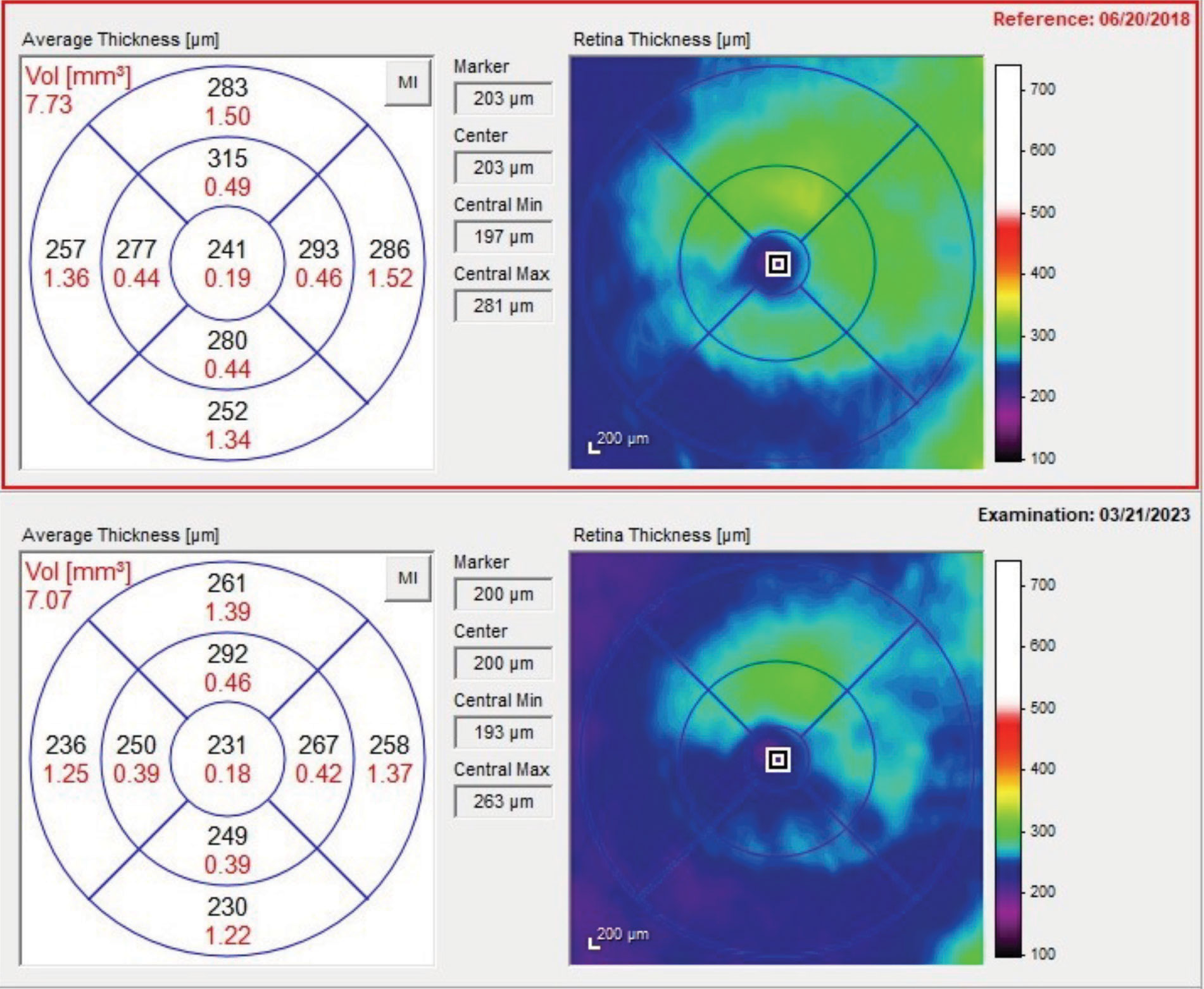 Retinal thickness changes seen from the baseline scan in 2018 to the most recent scan in 2023. Note the significant thinning of the retina in the inferior temporal arcuate region.