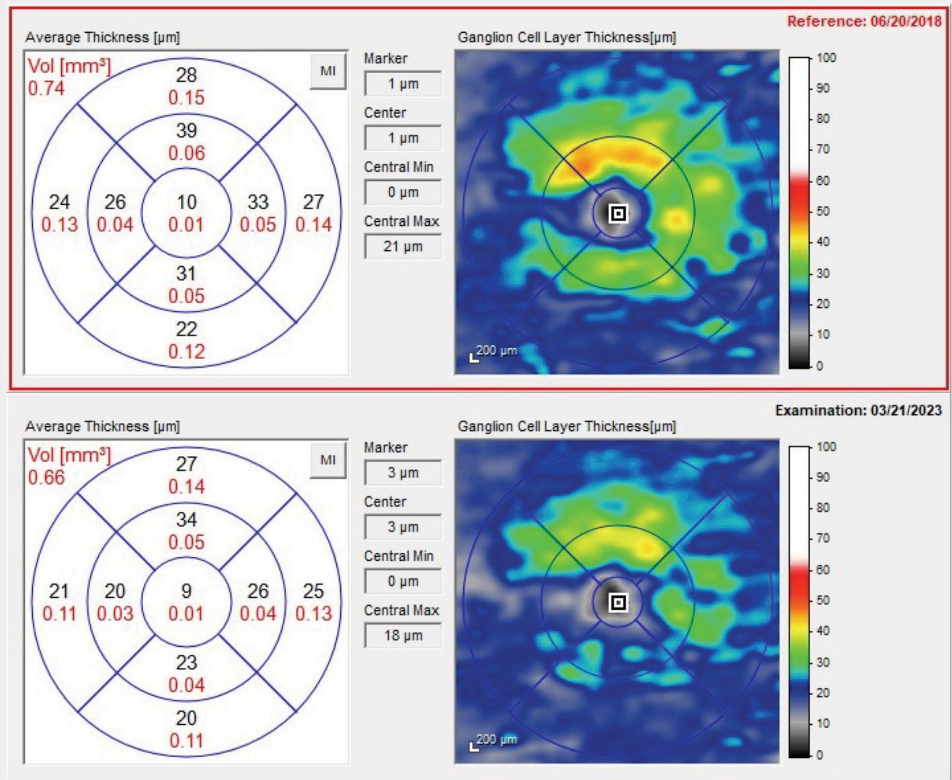 The baseline and current GCL thickness maps. Note the significant loss of thickness seen in the 2023 scan.