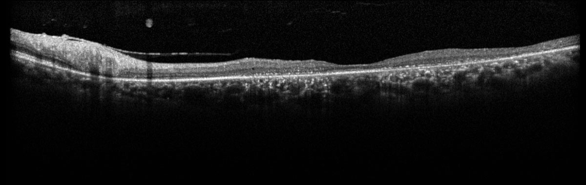 Fig. 1. Heidelberg SD-OCT of the left macula.