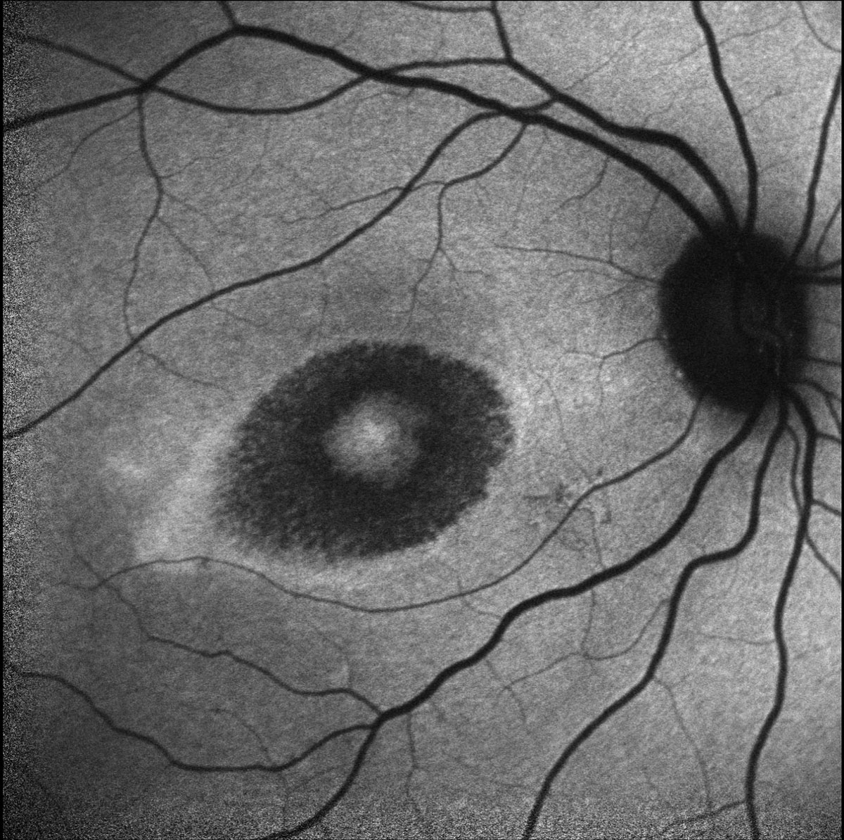 Fig. 3. Heidelberg fundus autofluorescence of the right eye.