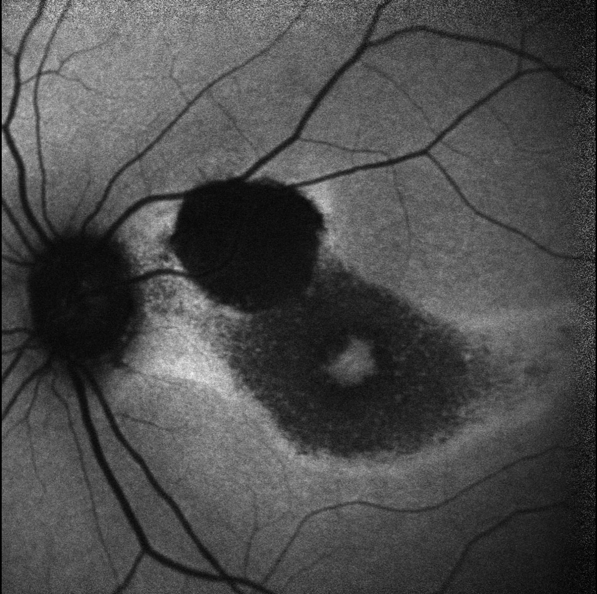 Figs. 4. Heidelberg fundus autofluorescence of the left eye.