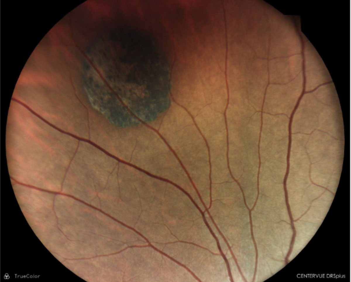 CHRPE; well-demarcated lesion with lacunae within.