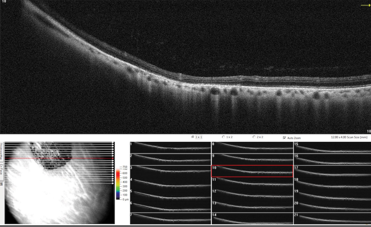 Timing the Retinal Referral: Tips for Success