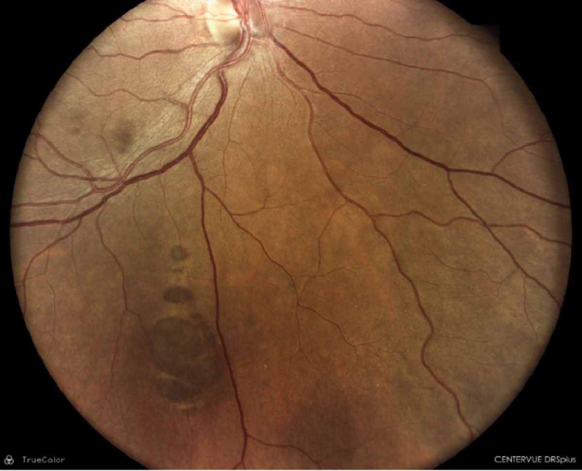 Scattered CHRPE with depigmented tails and irregular borders.