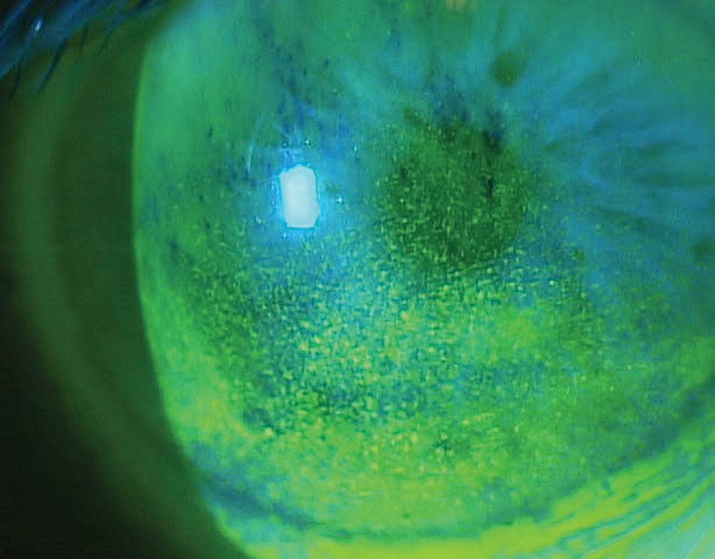 Preservatives, phosphate content, pH and viscosity of glaucoma eye drops can have an adverse effect on the ocular surface in these patients.