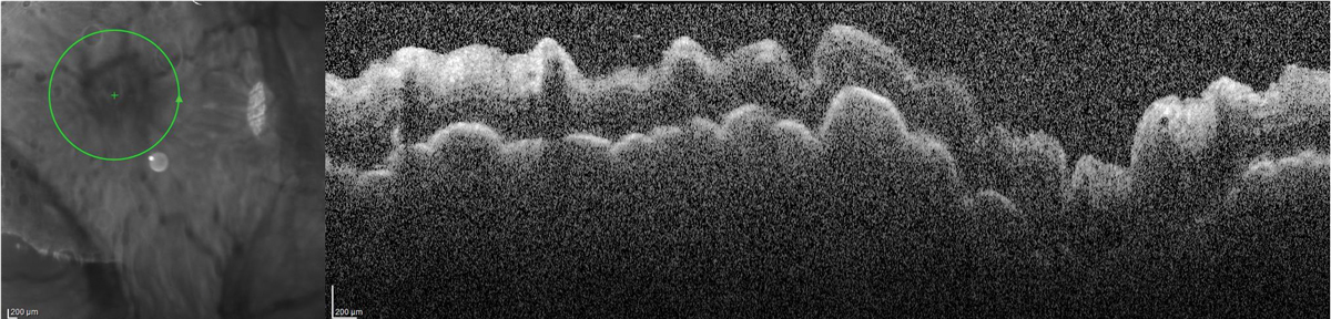 Peripapillary OCT demonstrating chorioretinal folds in the setting of hypotony.