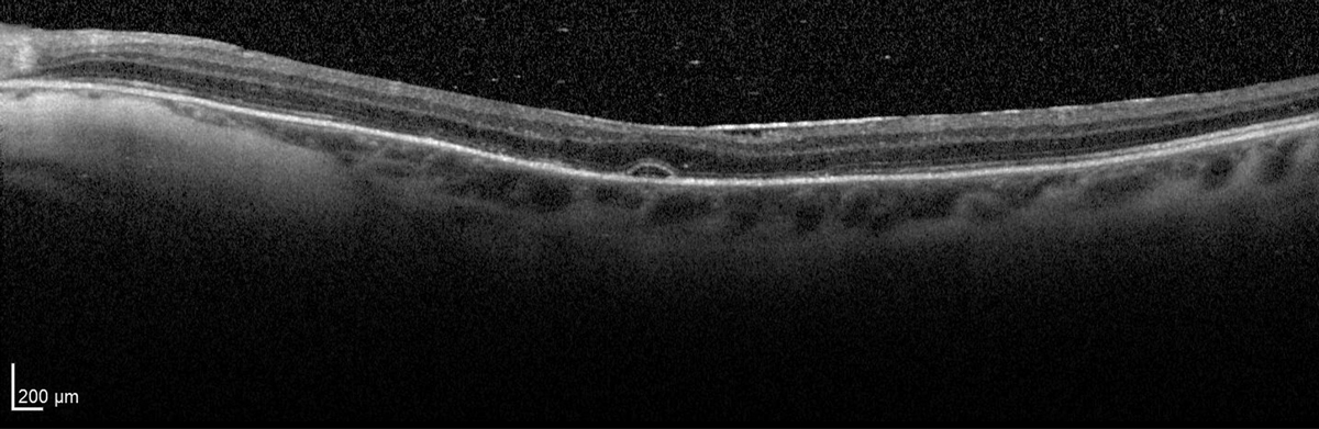 Resolution of chorioretinal folds with remaining focal serous detachment at day five.