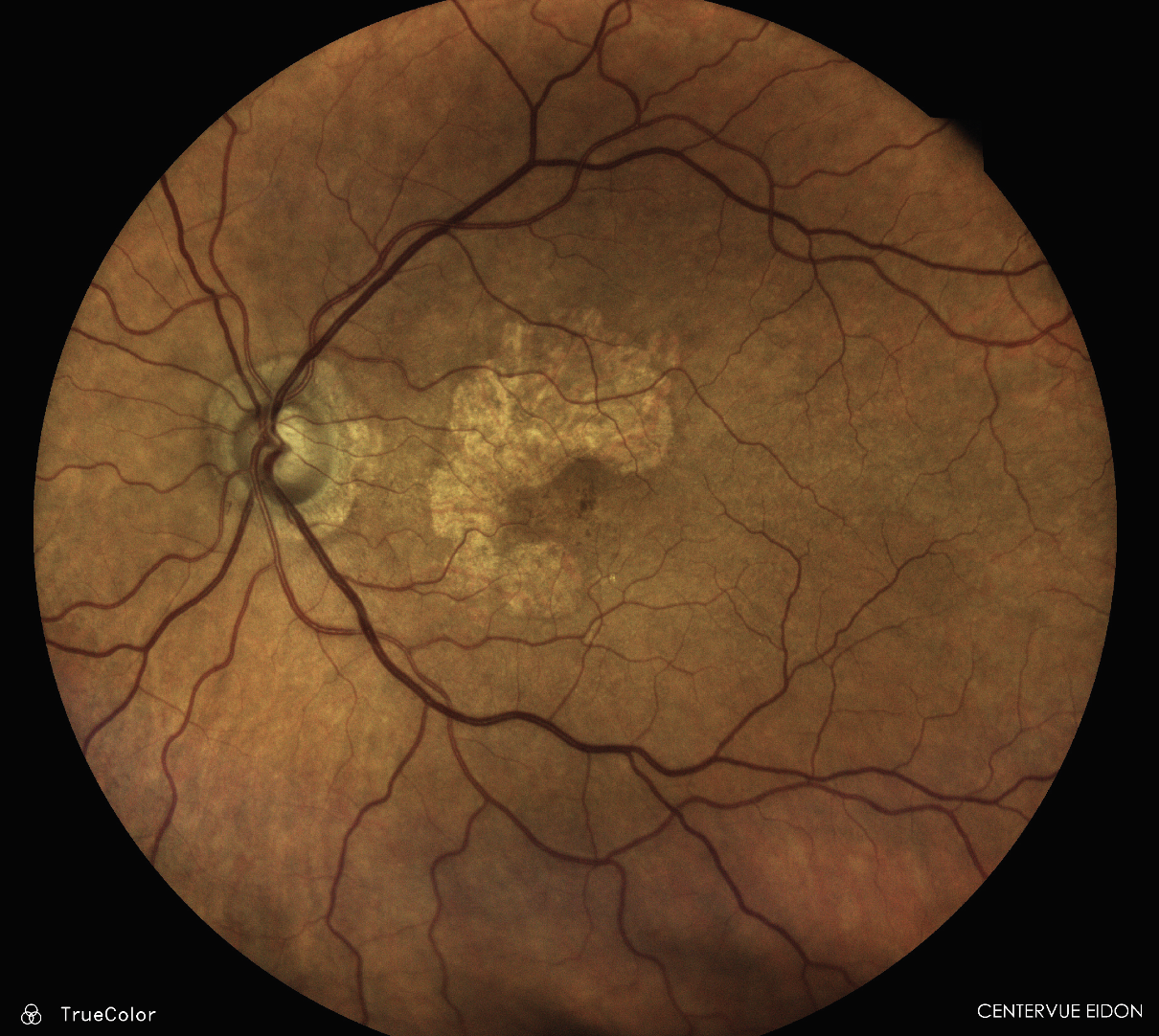 GA, easily identified with the iCare Eidon Widefield TrueColor Confocal scanner.