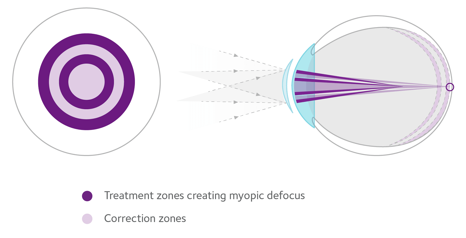 Accommodative amplitude, lag and facility was not affected long-term for children wearing multifocal contact lenses for myopia control.