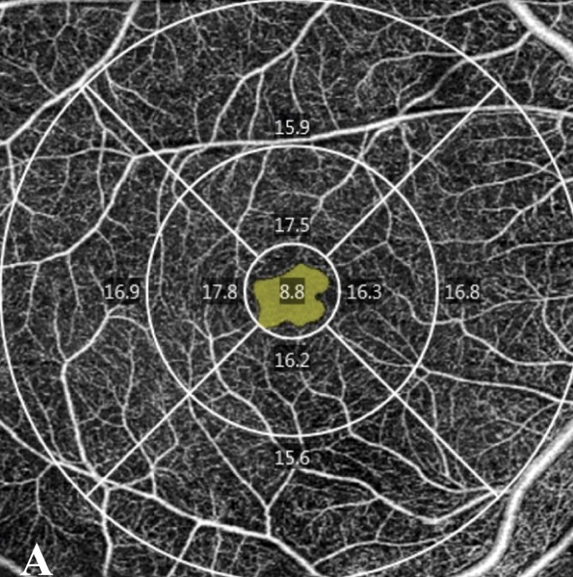 The clear, detailed view of retinal microvasculature provided by OCT angiography offers a strong diagnostic adjunct without the invasive dye injection of traditionally used fluorescein angiography. This 6x6mm scan shows the vessel density of the different regions of the macula and the foveal avascular zone.