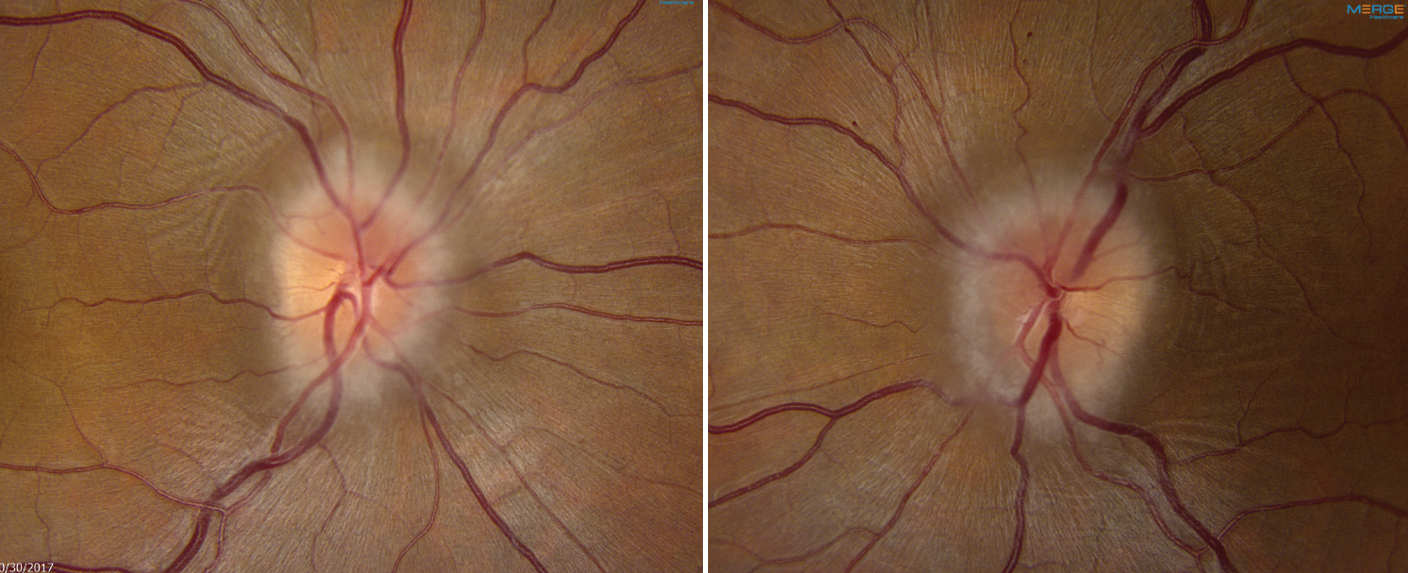 Relapse triggers were present in most episodes of papilledema recurrence in the study cohort and included medication changes, weight gain and cerebrospinal fluid shunt malfunction. 