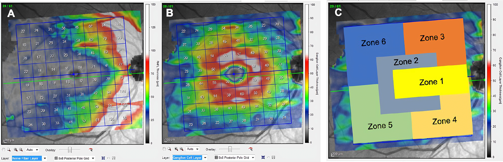 A Spectralis OCT testing mode called the posterior pole protocol found a correlation between RNFL and GCL thickness and disability status in MS that indicates disease severity prognosis. Warm colors represent higher thickness values and cool colors show thinner regions. Fig. A shows the averaged RNFL values of all study subjects while B shows that of the GCL. Fig. C denotes six proposed zones to track that may manifest differently at various stages of the disease.