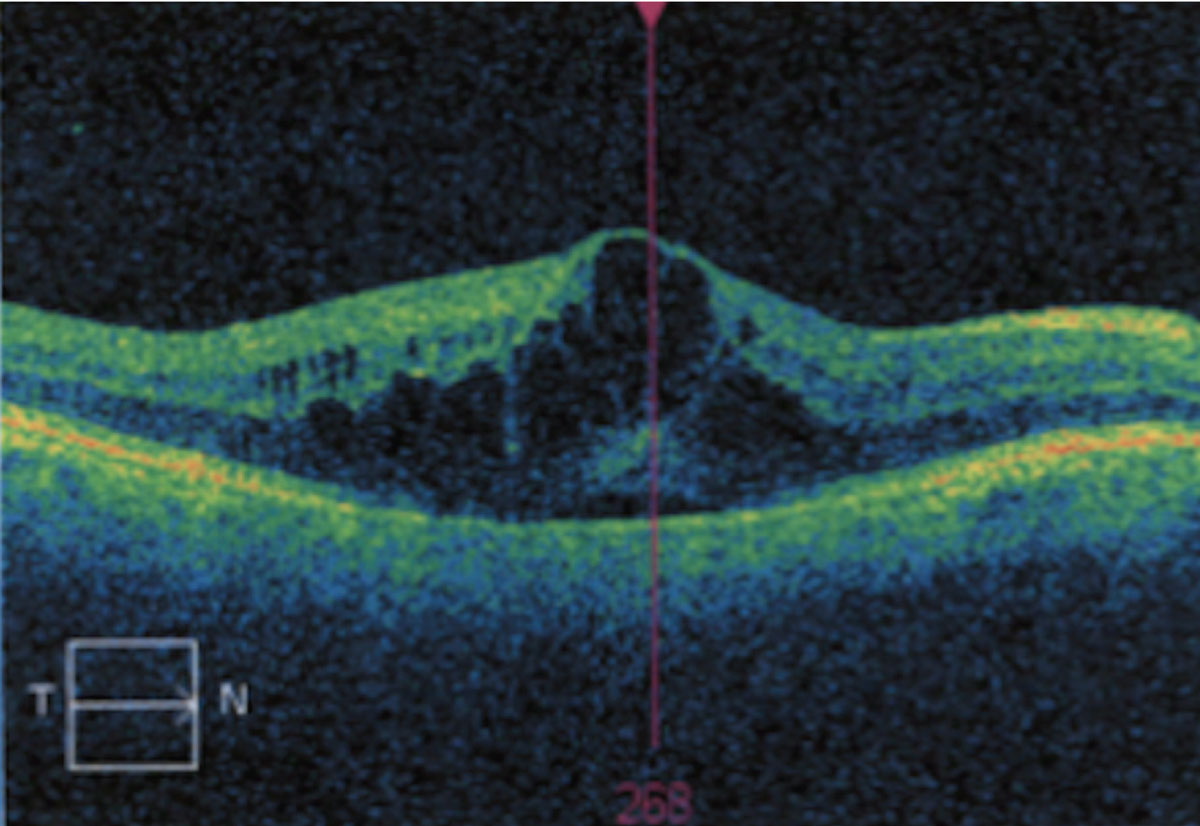 Cystoid macular edema resulting from fluid accumulation.