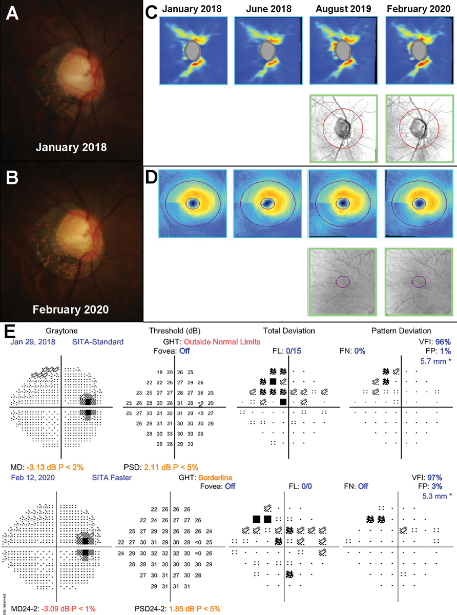 Fig. 1. An example of myopic optic neuropathy in a 47-year-old patient. A to B: Fundus photographs showed no change in the disc appearance between January 2019 and February 2020. C to D: There was no evidence of structural progression on the RNFL and ganglion cell inner plexiform layer (GC-IPL) guided progression analyses. E: 24-2 SITA-Standard VFs also did not show worsening of the existing superonasal defect.