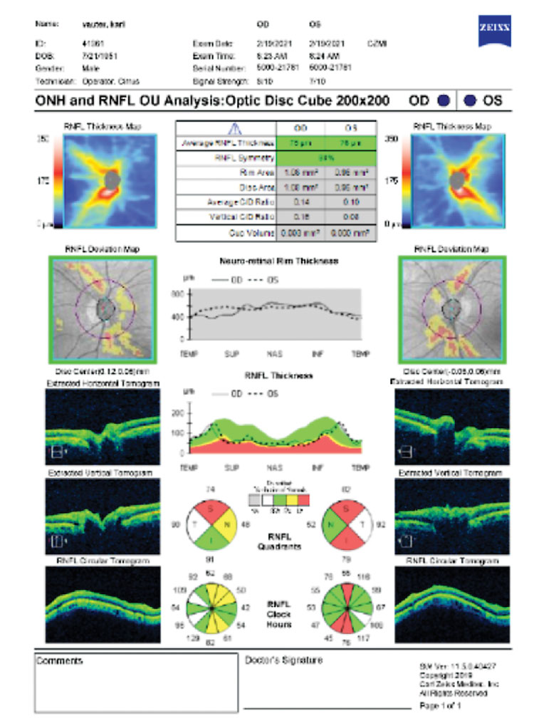 OCT showing areas designated as being outside normal limits but is merely a myope with a temporization of the RNFL peak.