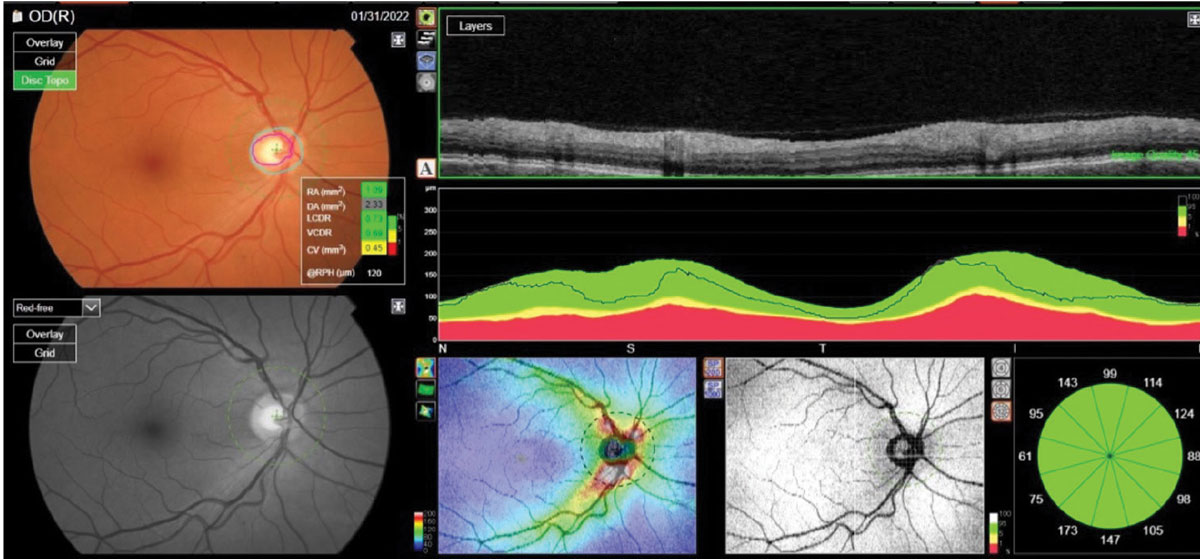 The reference database plots of a patient’s RNFL circle scan in an NSTIN format. Metrics of the right optic nerve raised questions; namely, a larger cup-to-disc ratio than seen clinically.