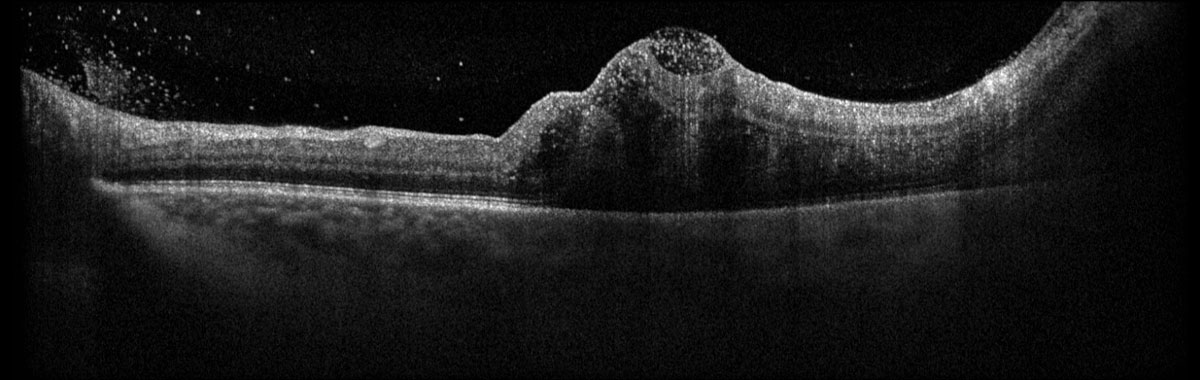 Fig. 2. Heidelberg Spectralis OCT of the left macula at presentation.