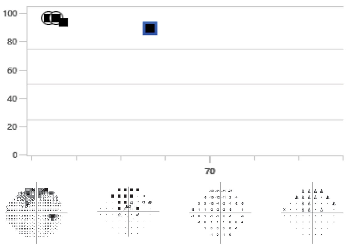 A 68-year-old patient whose visual fields on both event and trend analysis may have progressed when compared to baselines. This patient’s OCTs and clinical appearance do not show signs of progression. The event analysis displays “possible progression.” It is recommended that the visual field be repeated an additional time to confirm progression.