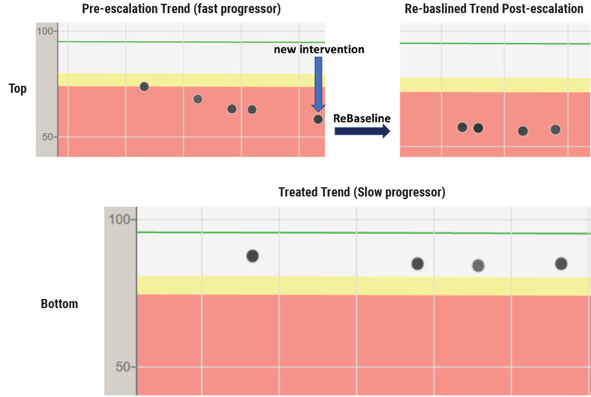 OCT trend analysis on a fast progressor with POAG that may have been detected earlier with more initial OCTs (top row). This patient progressed at a rapid rate (-5µm/year) despite intervention on the left image. Treatment was subsequently escalated (blue arrow) and the right image reflects that no additional RNFL tissue loss occurred on the re-baselined (dark arrow) trend analysis. Bottom image shows an extremely slow progressor (<-1µm/year) who was initially put on a second medication because of not meeting target IOP. After the trend analysis showed stability, the patient had the second medication removed and the tissue has remained stable on one medication—a good reminder that OCT biomarkers can guide decision-making.