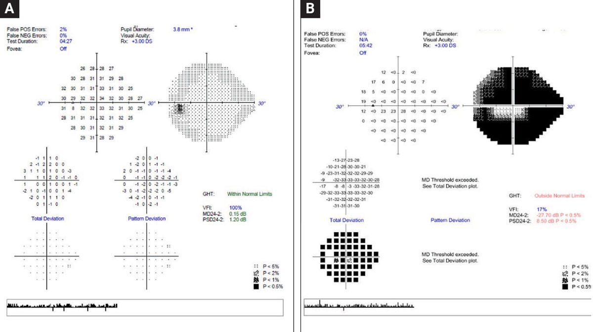 With the goal of preventing progression from Fig. A to Fig. B, a major emphasis is to identify those at greatest risk and knowing associated risk factors. For example, faster progressors are at greater risk of experiencing loss of vision and subsequently experience lower quality of life. Conversely, recognizing that slow progressors with longer expected life expectancy is also a risk for advanced disease progression is also vital.