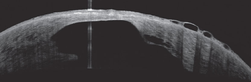 Decreased corneal thickness is the strongest predictor risk for developing hydrops.