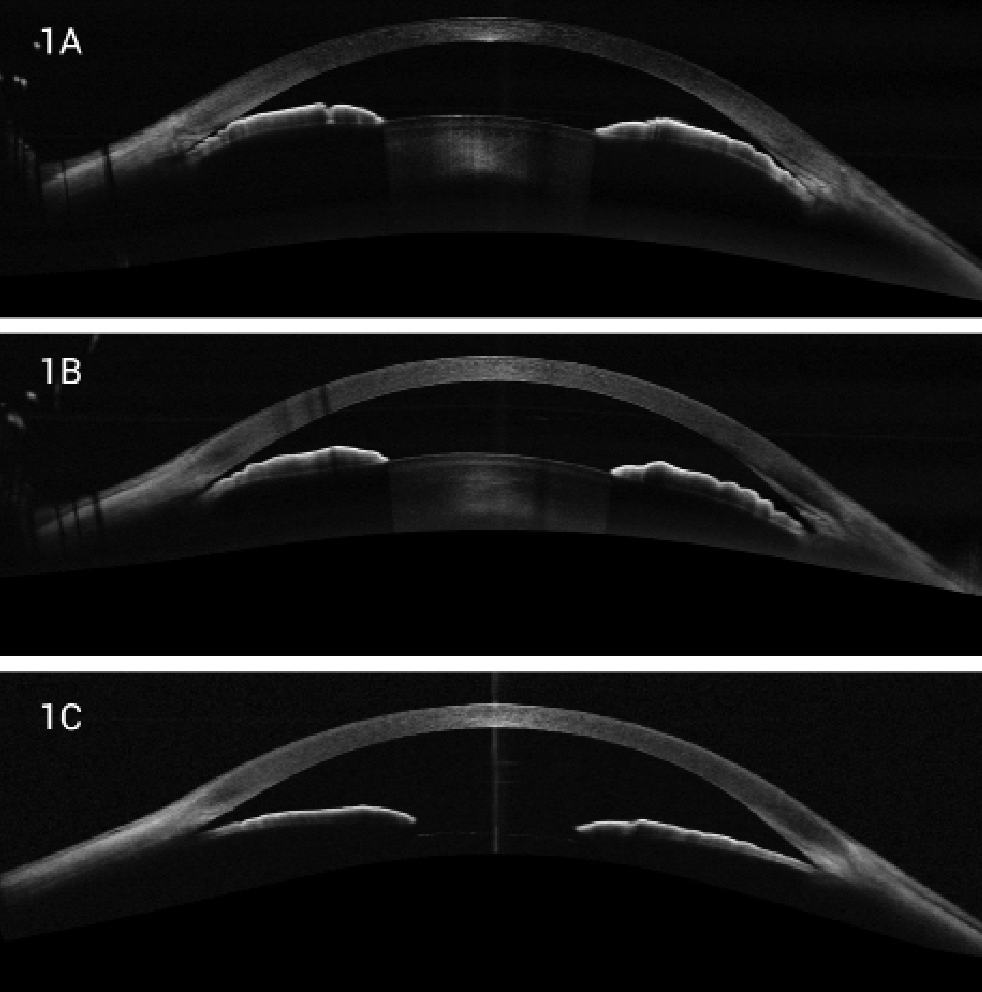 Managing Patients Across the Narrow-Angle Spectrum