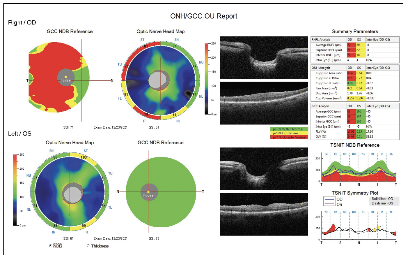 Fig. 4. OCT shows a reduced ganglion cell complex and nerve fiber layer in the patient from case 2. Note the significant asymmetry in the ST and IT sectors in the TSNIT Symmetry Plot.