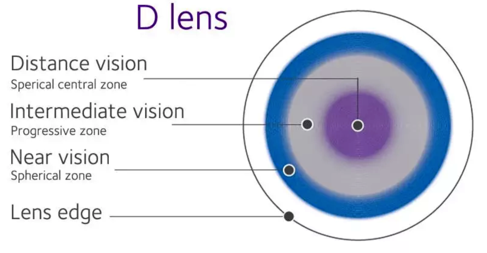 High add power, despite contributing to visual differences, likely does not affect children’s visual-related quality of life in myopia management.