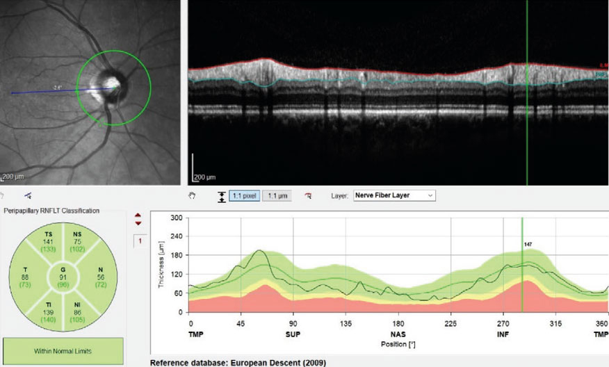 So-called “green disease” misrepresents an eye as normal, concealing pathology due to inadequacies in the reference database. The converse, red disease, suggests disease presence when there is none. A new effort envisions more a robust, real-world database derived from optometric practices that would reduce such errors.