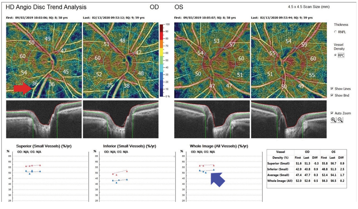 Reduced vessel density and microvascular dropout may also be the result of glaucomatous progression. Long-term changes in these parameters and their relationship to progression will require further investigation. Image above (not from the study) shows a nerve fiber layer defect (red arrow) and optic nerve perfusion improvement after treatment (blue arrow).