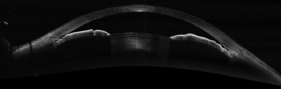 These findings raise questions about the clinical convention of solely assessing angles in the dark as well as the ideal lighting conditions to risk-stratify patients who are PAC suspects for more severe disease.