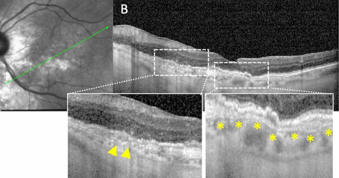 While subclinical angioid streaks and AMD share some differences in pathogenesis, their shared features and high prevalence in the AMD population warrant consideration for angioid streaks as an AMD phenotype. The above images from the study show Bruch’s membrane dehiscences (a; red line), breaks (b; yellow triangles) and undulations (a, b; yellow asterisks).