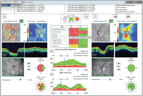 More than 5% of patients with ocular hypertension at baseline went on to develop POAG by six years in this Singapore-based study.