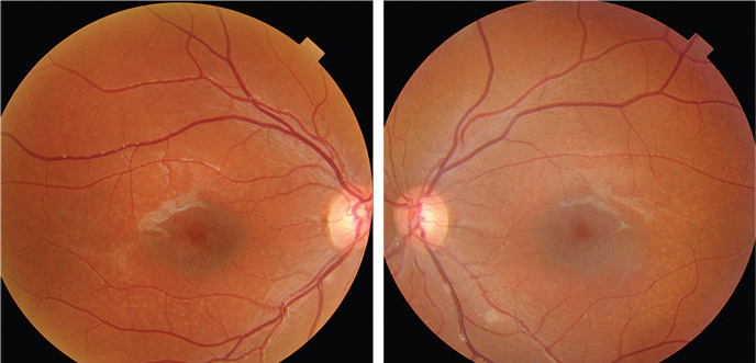 Misdiagnosis of Stargardt’s disease as AMD should be avoided to prevent futile invasive treatments with potential complications.