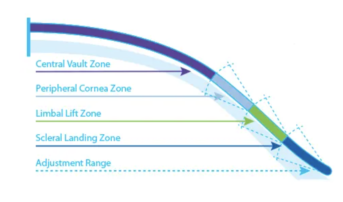 The customizable zones of the Ambleye scleral lens, which recently acquired a microvault option for patients with scleral abnormalities such as pingueculae.