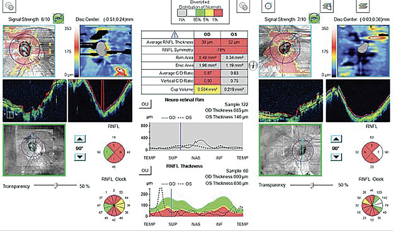 This study found a much higher prevalence rate of imaging artifacts in high myopes vs. non-myopes, which researchers suggest may be due to various factors such as globe elongation and posterior pole disruption. The above abnormal OCT shows poor segmentation in both the heat maps and tomograms in a high myope. 