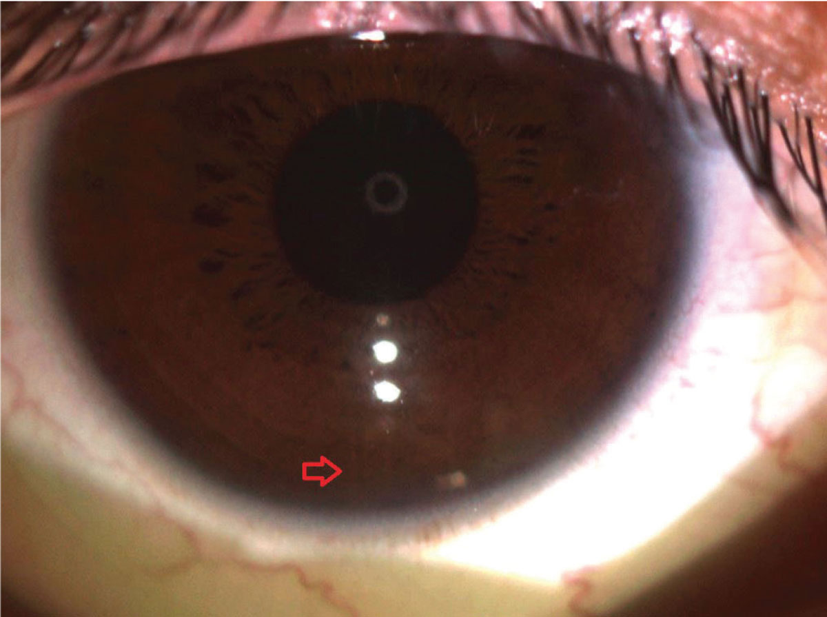 Fig. 1. Determining the appropriate cylinder axis is essential to ensure the best quality of vision. Pictured here is a soft toric lens aligned at six o’clock.