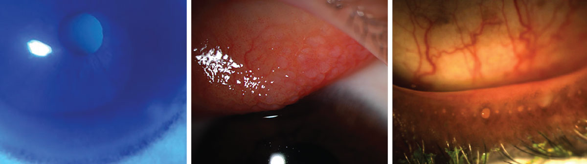 Fig. 3. Different ocular conditions affecting the ability to wear contact lenses will have to be treated prior to the intial fitting and will require a specific fitting approach (left to right: keratoconus with Fleisher ring, giant papillary conjunctivitis and meibomian gland dysfunction).