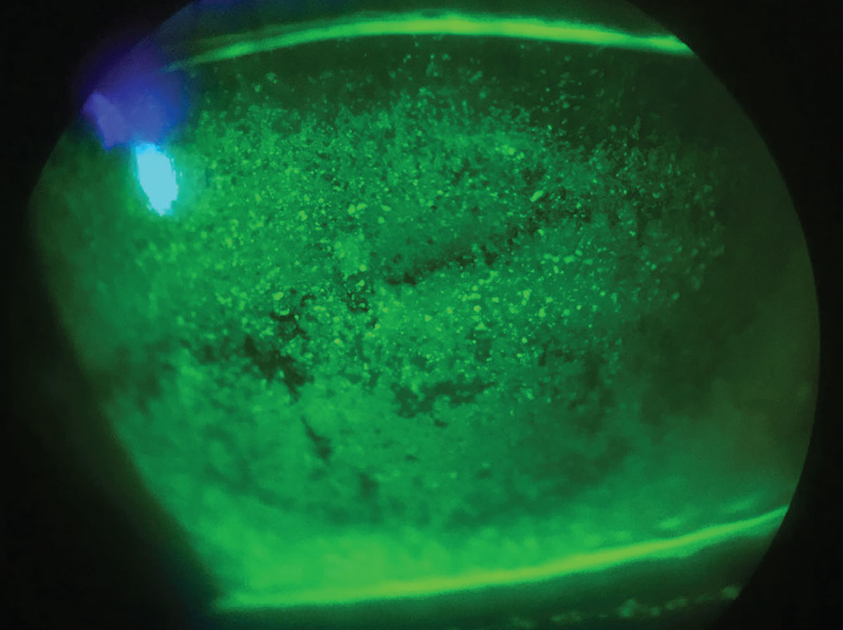 Fig. 4. Patients with signs and/or symptoms of dry eye may need to be evaluated and treated prior to contact lens selection and fitting.