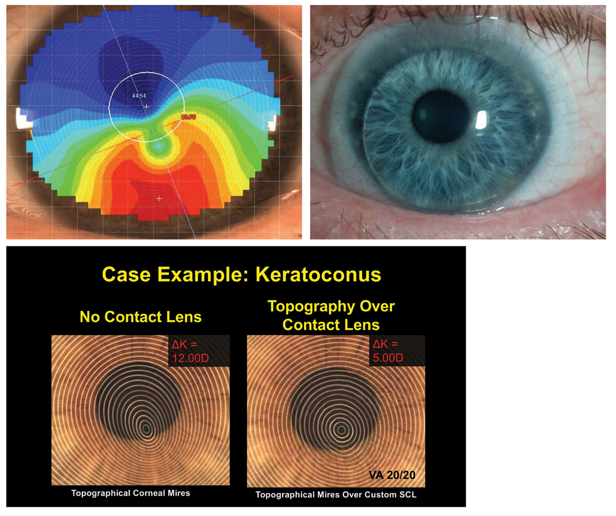 Figs. 3 and 4. Note the thickened custom soft lens that has decreased the corneal distortion in this patient with irregular corneal toricity over the visual axis.