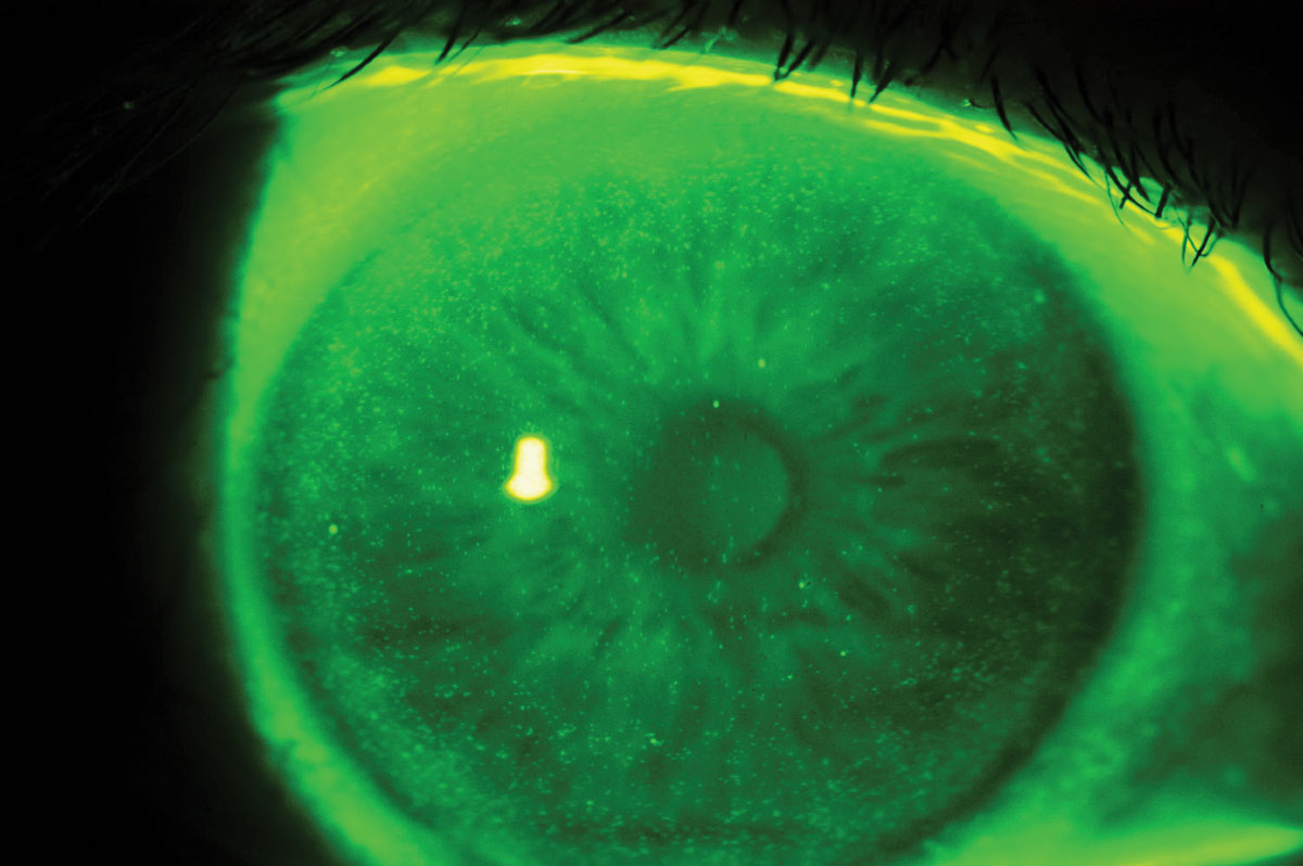 Fig. 6. Epithelial cells hyperfluorescence related to preservative agents reaction.