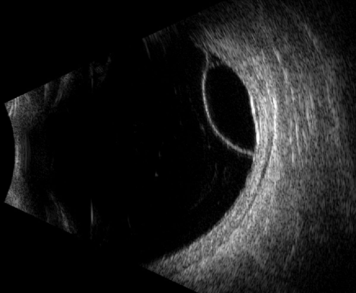 Fig. 3. Longitudinal B-scan of the right globe along the 7:30 meridian.