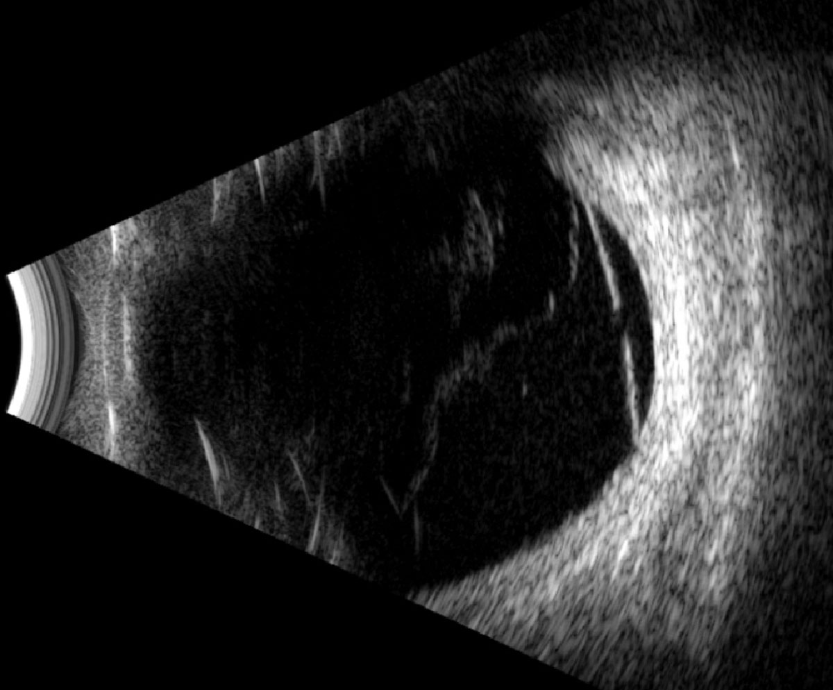 Fig. 4. Longitudinal B-scan of the left globe along the 1:30 meridian.