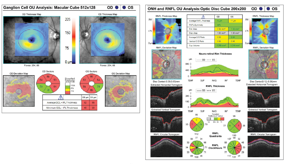 Fig. 2. Ganglion cell inner plexiform layer (left) and RNFL analysis (right) should be performed regularly on patients with MAC infection.