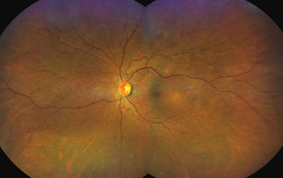 Here’s what the patient’s posterior segment exam looked like. See anything unusual?