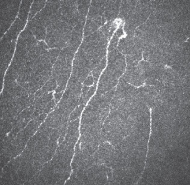 It is essential to know and understand the age-related changes that present in the cornea to be able to differentiate pathological changes from physiological degenerative processes during aging.